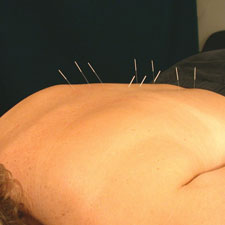 A patient receieving Acupuncture on their back